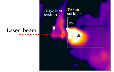 Bone ablation experiment: The laser beam is focused through the irrigation system onto the bone surface. A thermal camera is used for feedback on the ablation depth via detection of the point of maximum temperature (red triangle) on one of the faces perpendicular to the drilling face.