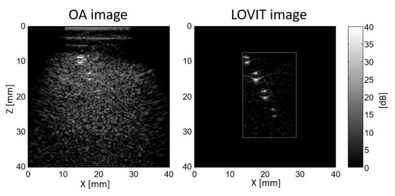 For clinical combined optoacoustic (OA) and ultrasound (US) imaging